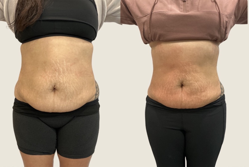 Abdomen and waist — before and after