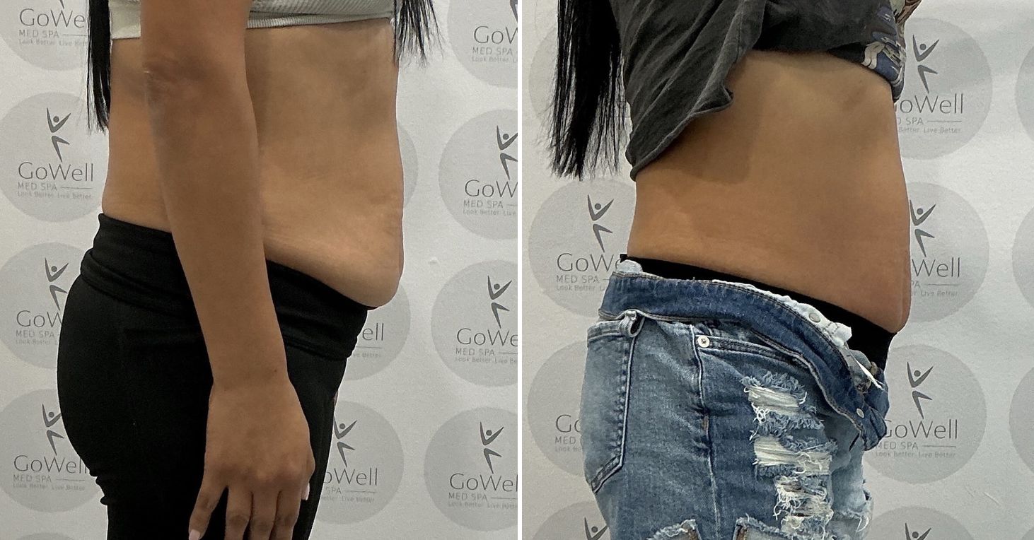 Abdomen — before and after