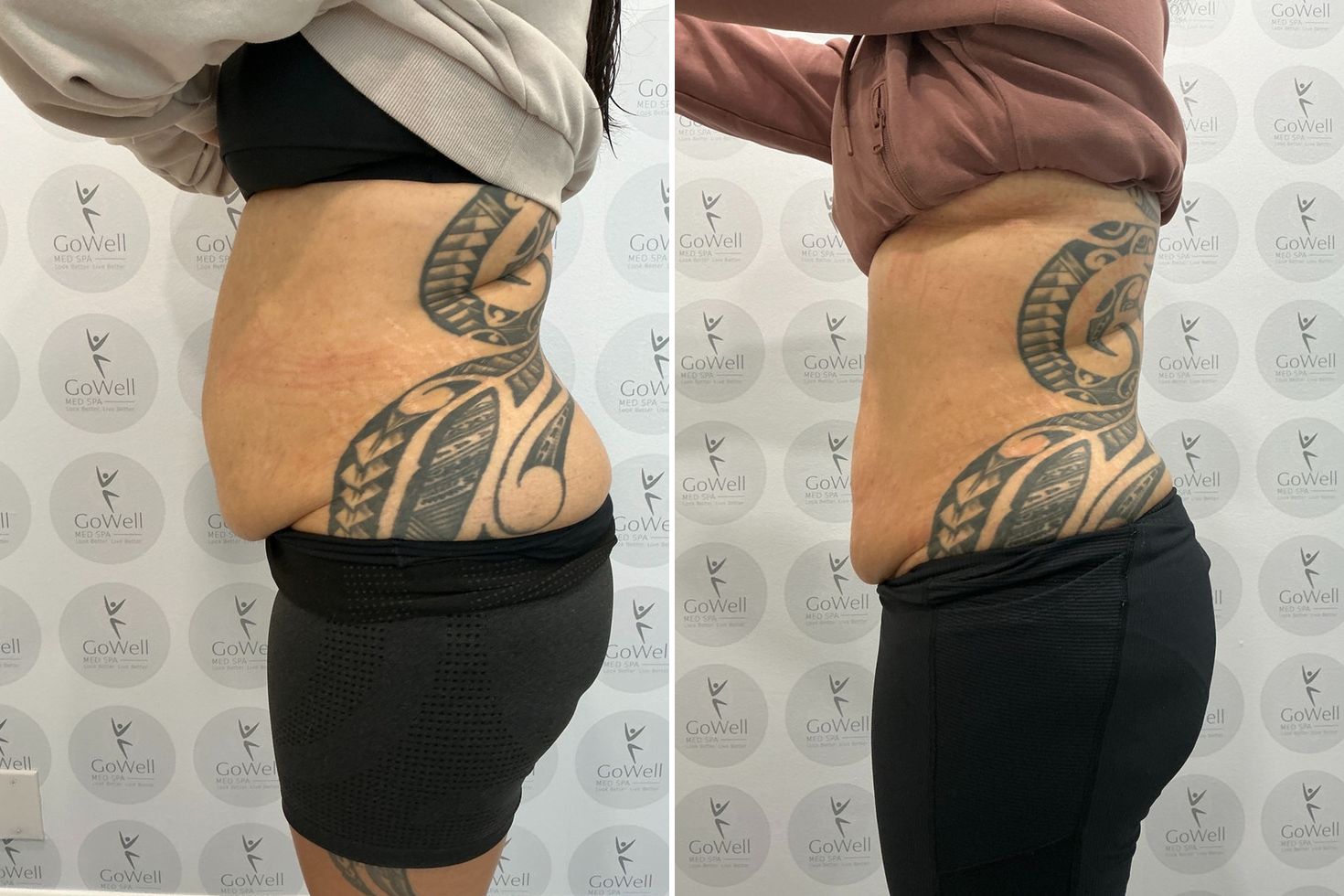 Abdomen and flanks — before and after