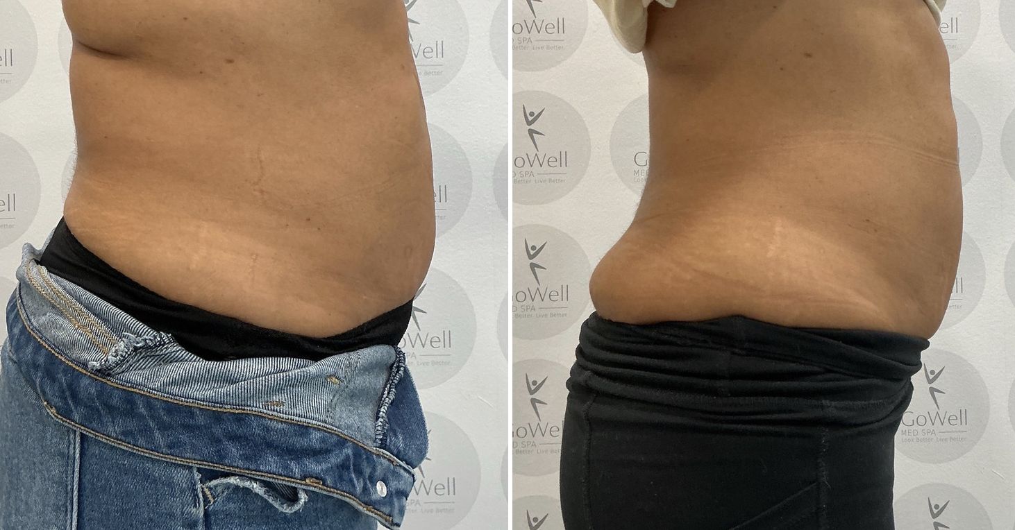 Abdomen and flanks — before and after