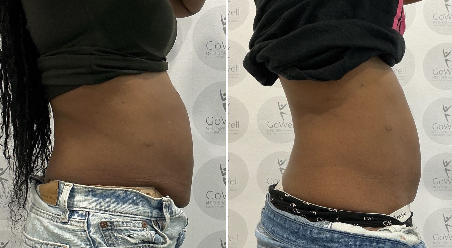 Abdomen — before and after