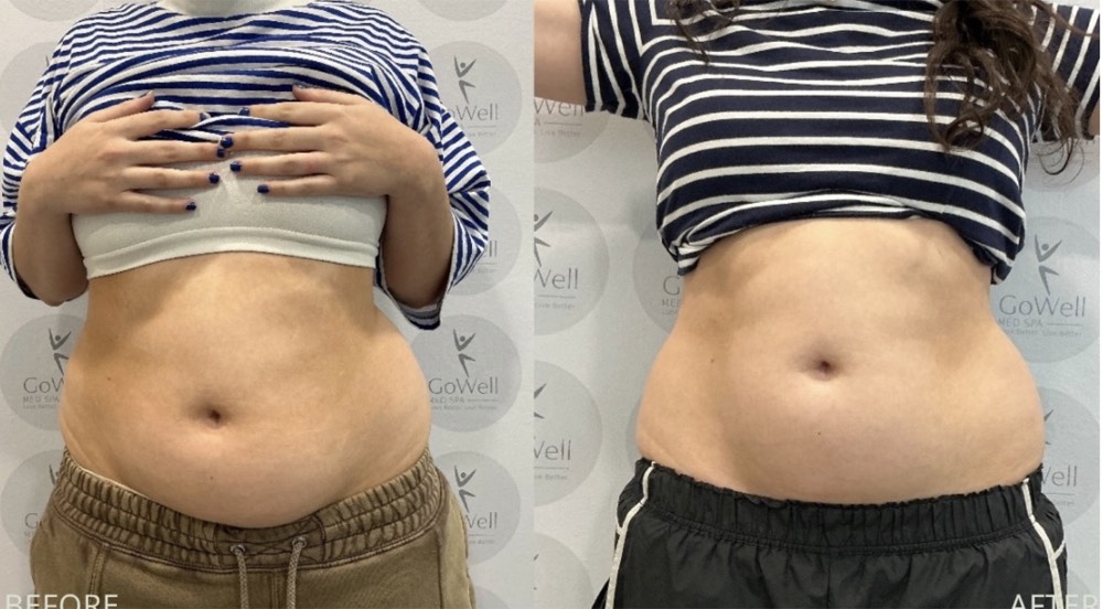 Abdomen — before and after