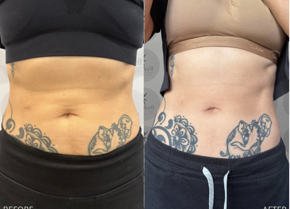 Abdomen — before and after
